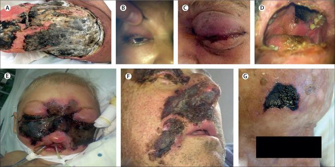 Mucormycosis in COVID-19 Patients