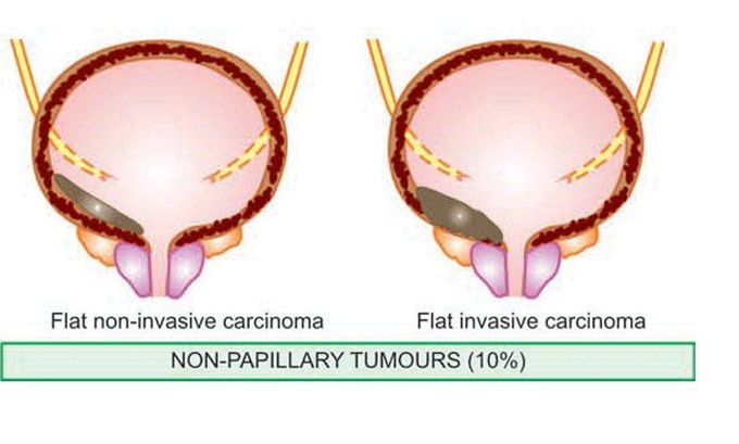 Epithelial bladder tumours