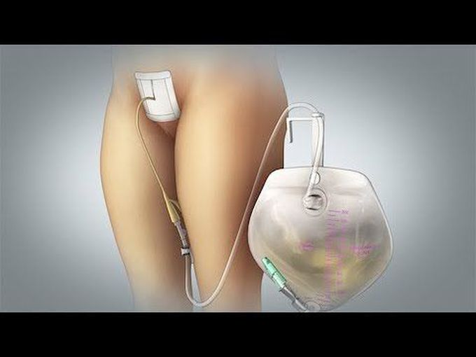 Caring For Your Suprapubic Catheter: Discharge Instructions