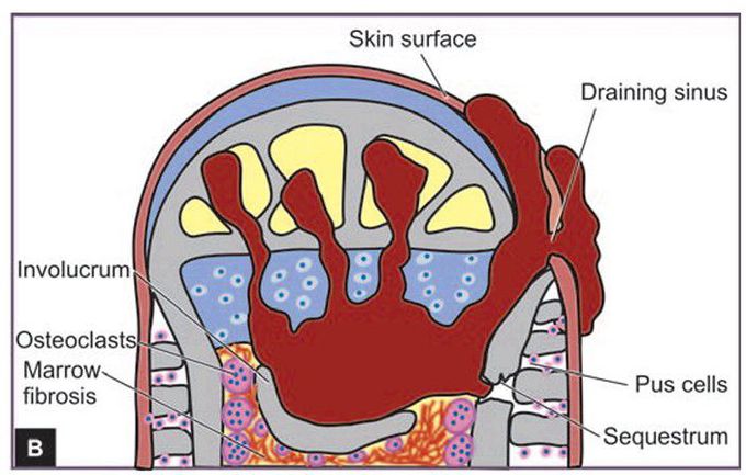 Pathogenesis of pyogenic osteomyelitis