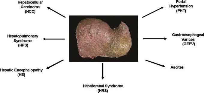 Complications of Liver Cirrhosis