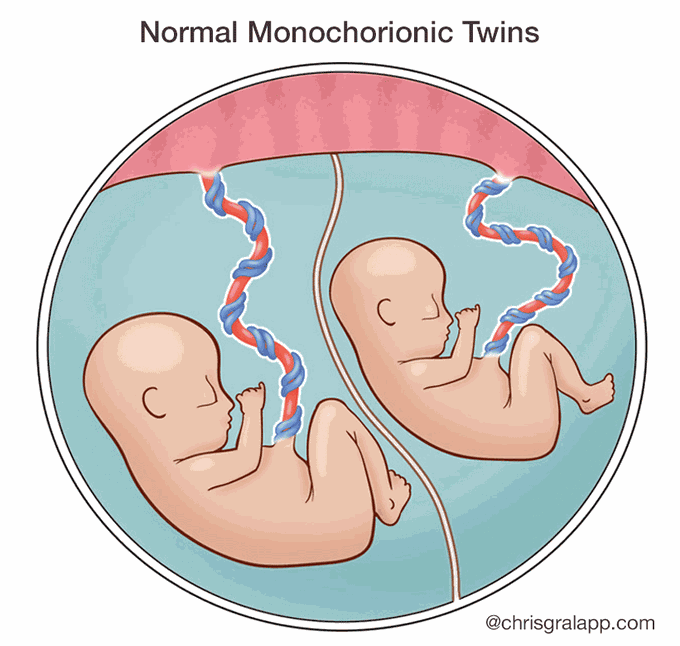 Twin-Twin Transfusion Syndrome (TTTS)