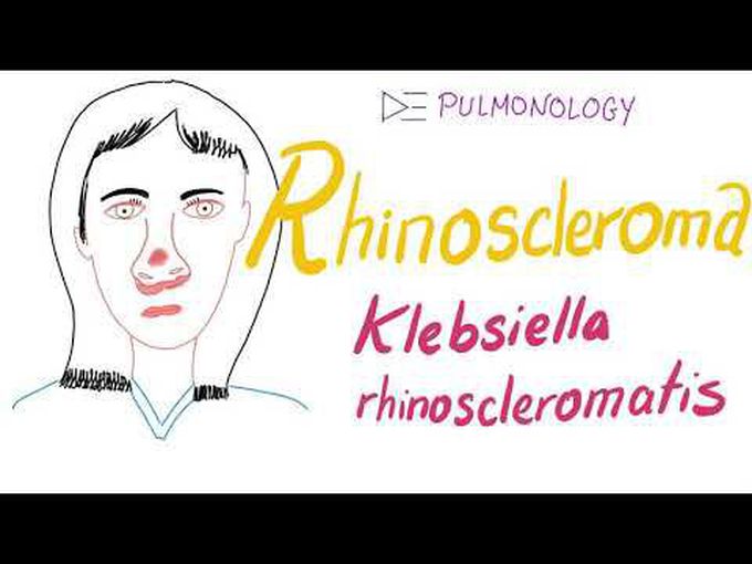 Rhinoscleroma (Klebsiella rhinoscleromatis)