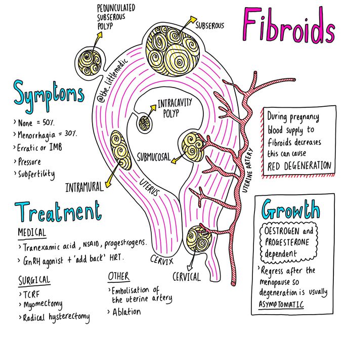 Fibroids