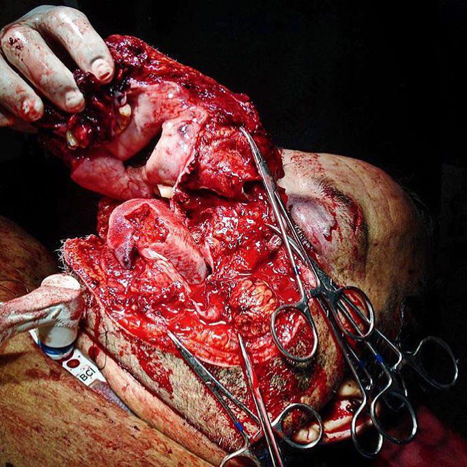 Facial trauma due to gas explosion