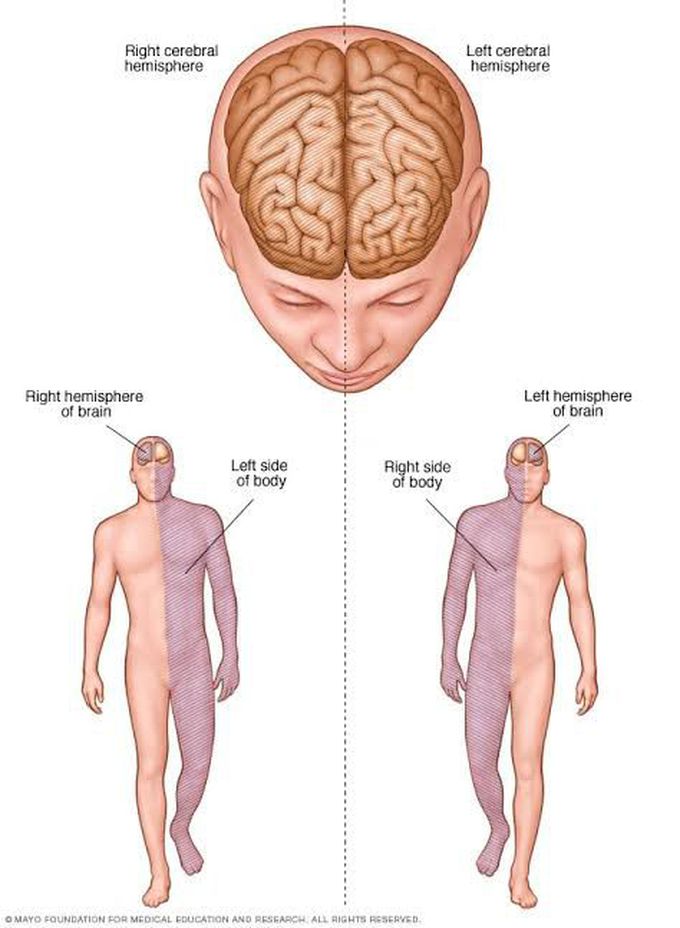 Ischemic stroke treatment