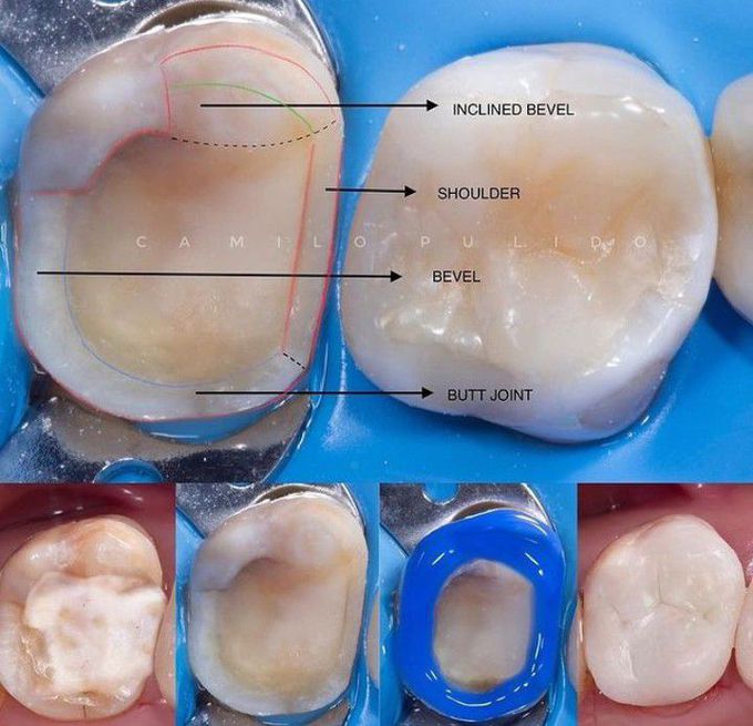 Lithum Disilicate Preparation