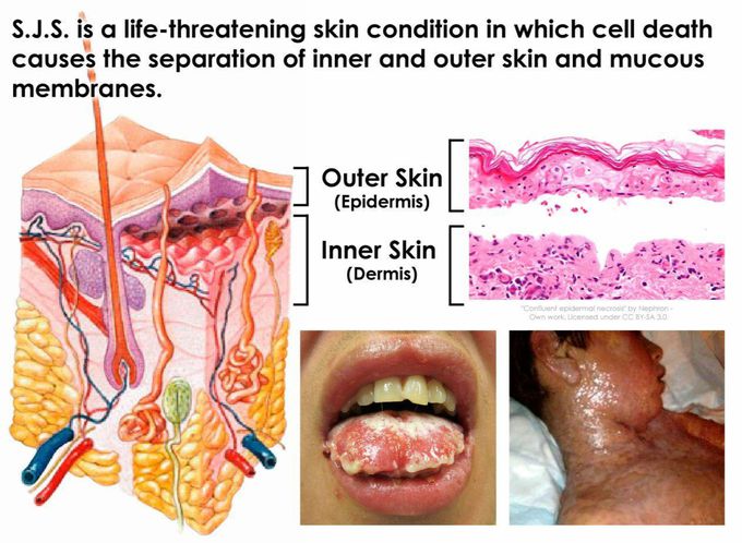 SJS disease