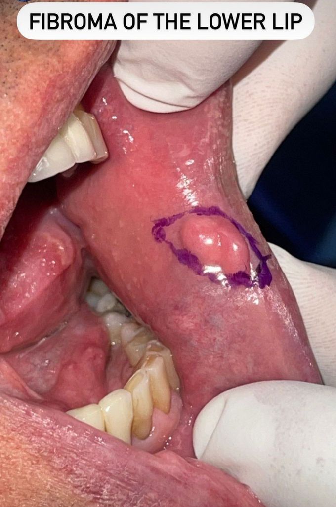 Fibroma of the Lower Lip