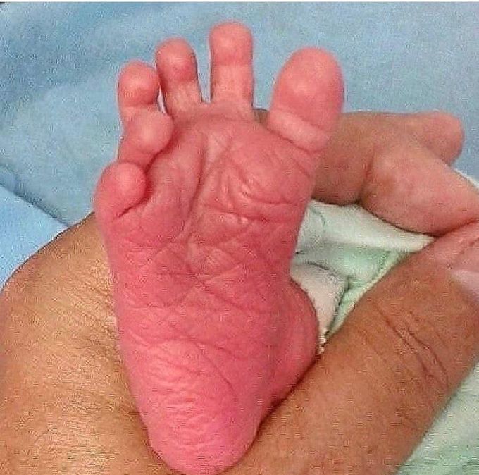 Polydactyly
