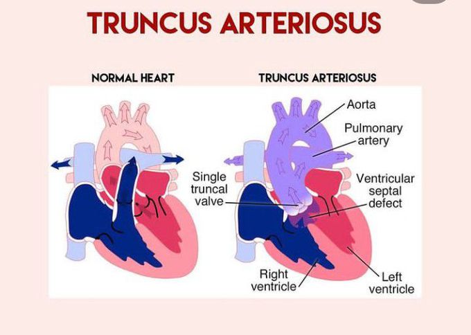 Truncus Arteriosus