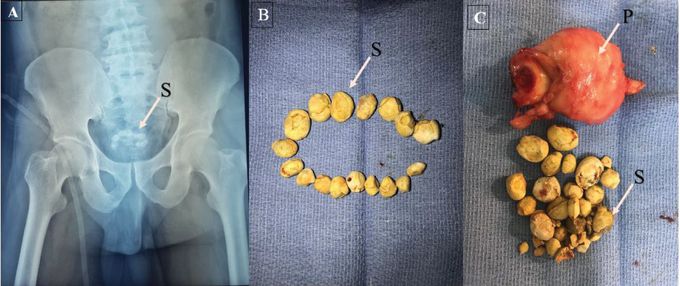 Multiple Stones in the Bladder