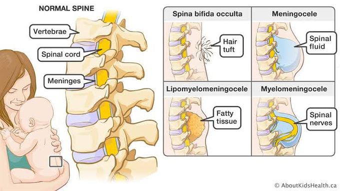 Spina Bifida Medizzy 9229