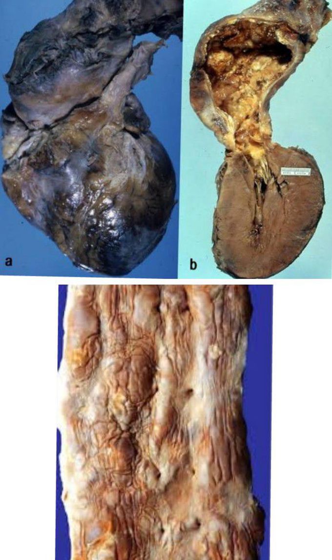 Syphilitic Aortitis