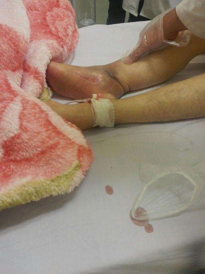 Diabetic wound in an eighty-year-old woman