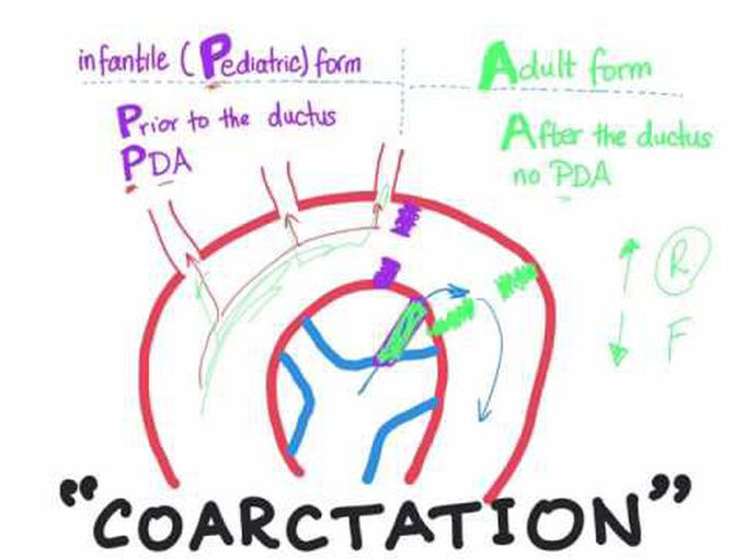 Coarctation of aorta (Infantile type vs adult type) mnemonic