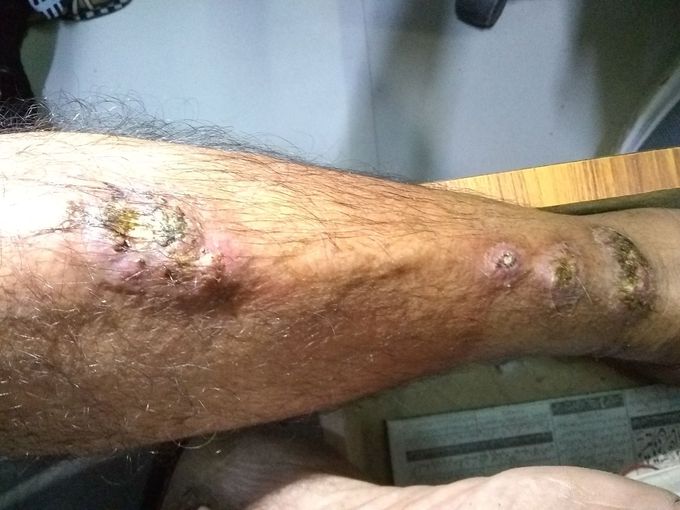 Leishmaniasis