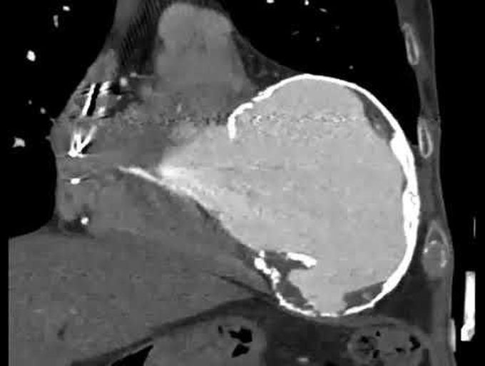 Left Ventricular Aneurysm