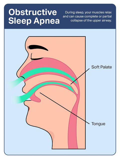 Causes of Obstructive sleep apnea - MEDizzy