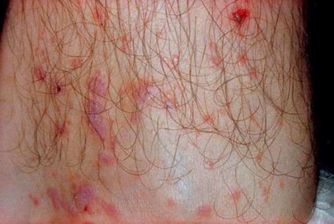 Cutaneous lichen planus