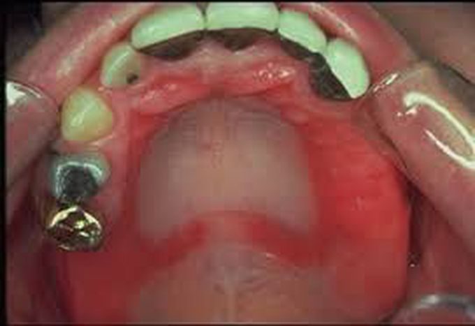 Denture stomatitis