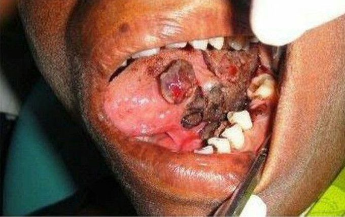 Hemorrhagic bullae