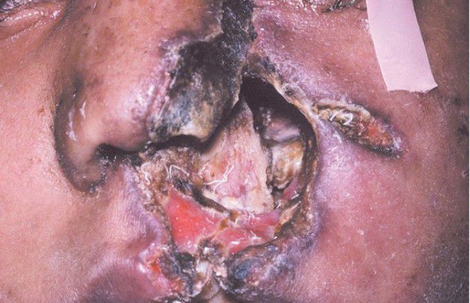 Mucormycosis