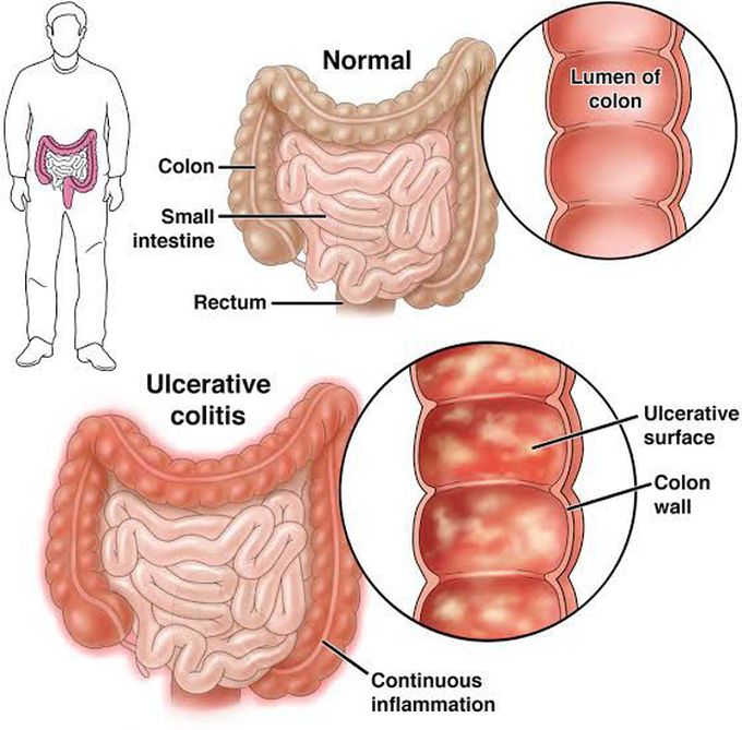Symptoms of ulcerative colitis