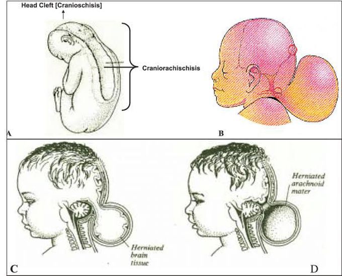 Cranioschisis