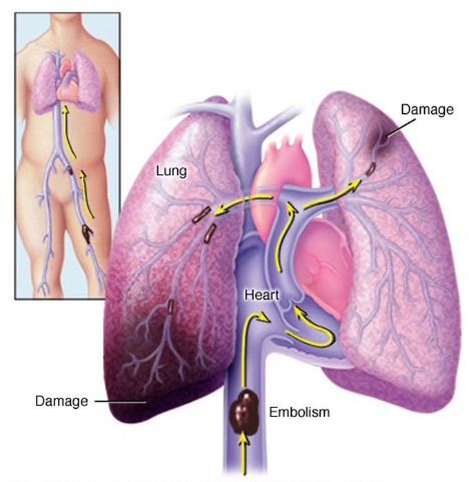 Pulmonary embolism