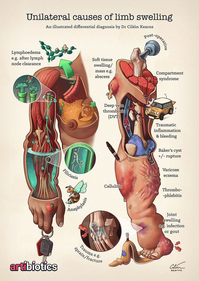 UL causes of limb swelling