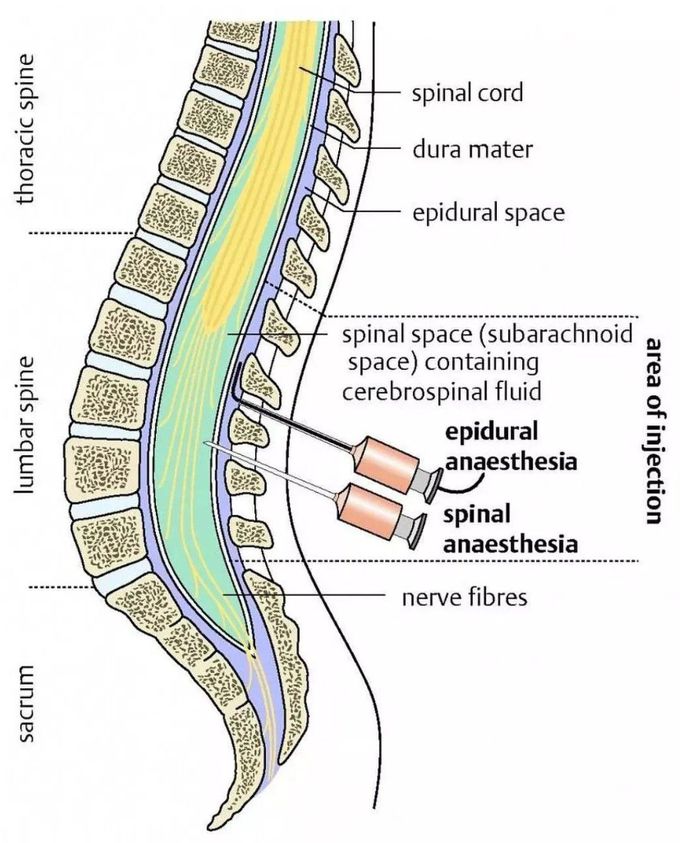 Epidural Vs Spinal Anesthesia