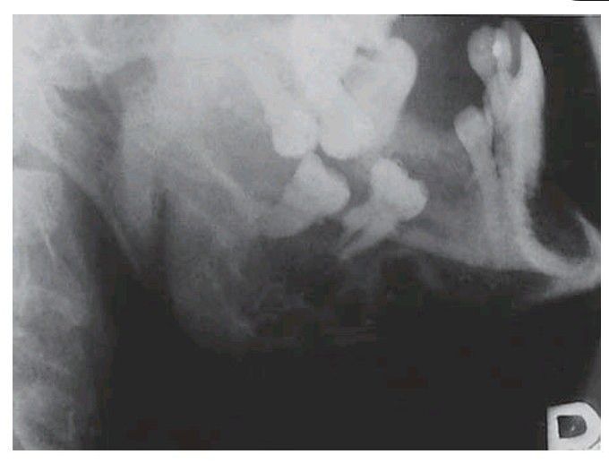 Hyperparathyroidism