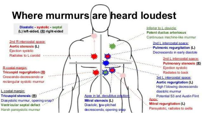 This Picture Will Help You Understanding Heart Murmur Medizzy
