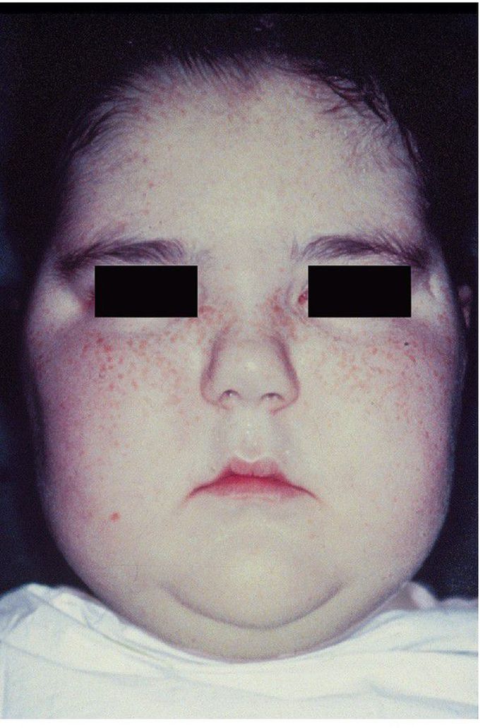 Cushing Syndrome.