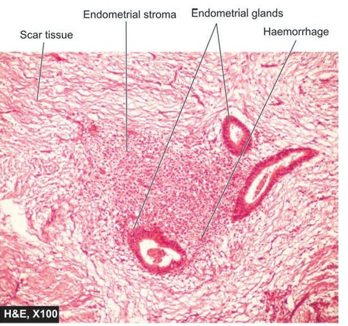 Endometriosis