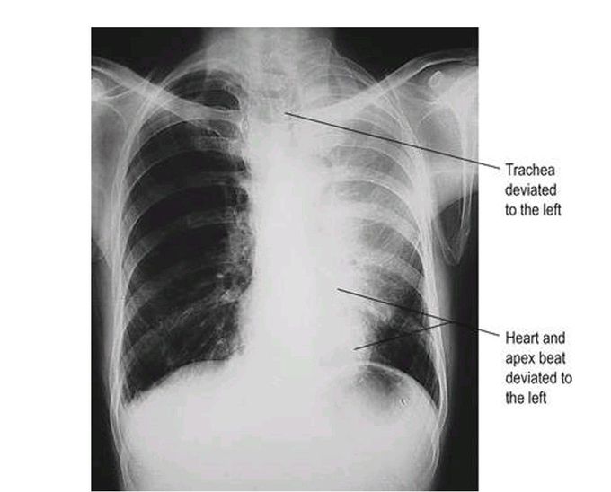 Collapse	of 	the	left 	upper	lobe of lung