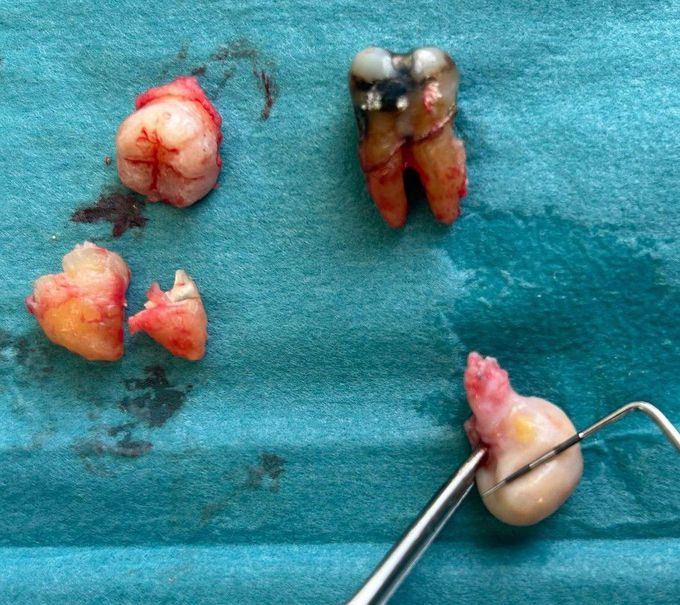 Cyst Extraction