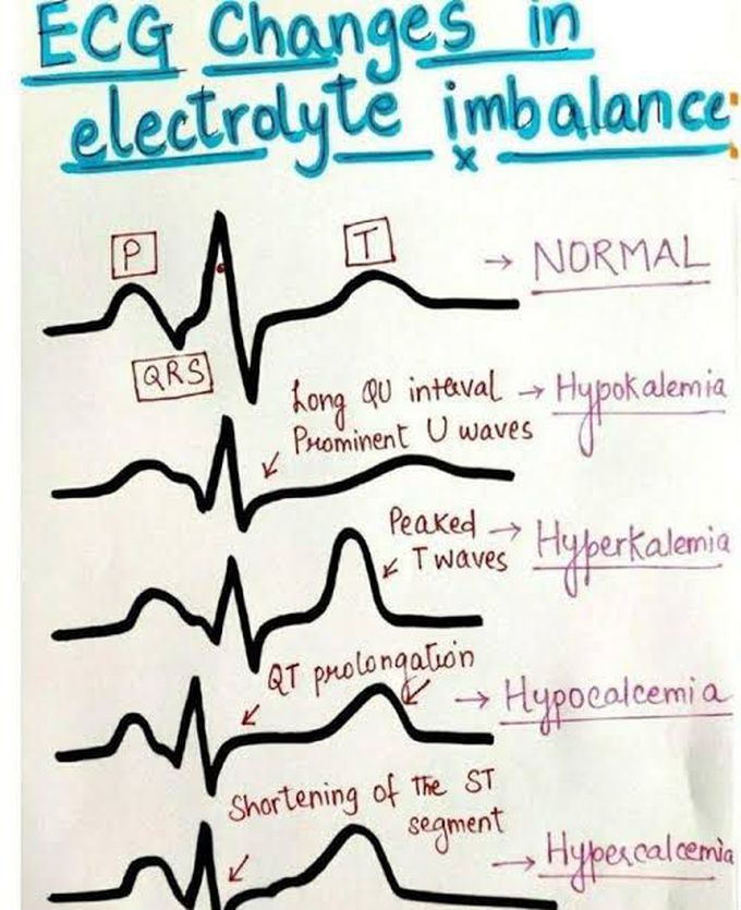 ECG changes in electrolyte imbalance