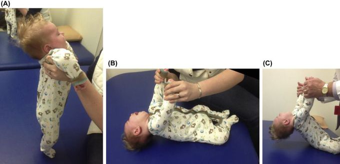 Werding hoffman disease