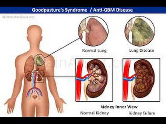 Goodpasture Syndrome