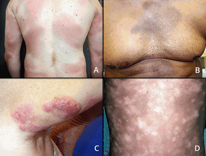 Cutaneous T-cell lymphoma