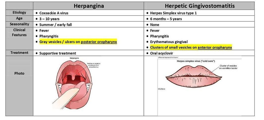 Herpangina Vs Herpetic Gingivostomatitis MEDizzy