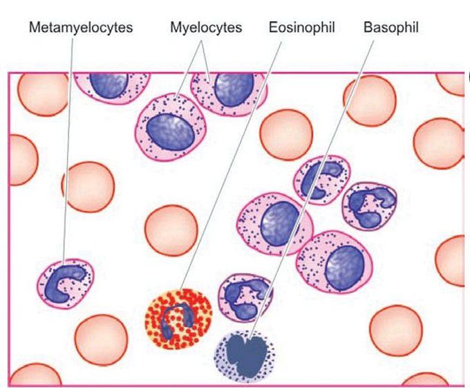 Chronic myeloid leukaemia (CML).