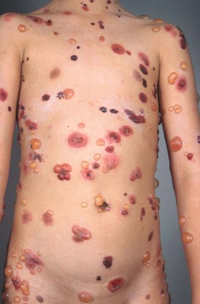 Bullous Pemphigoid