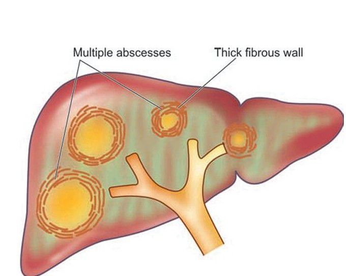 Pyogenic abscess