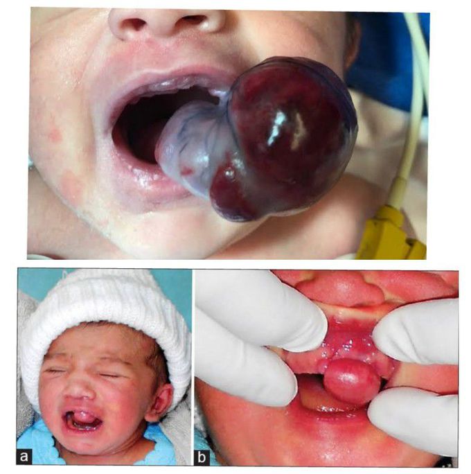 Congenital Granular Cell Epulis