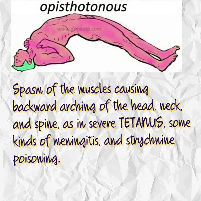 Opisthotonous