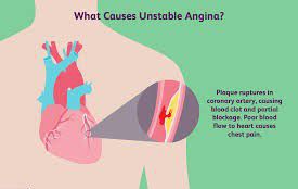 Causes of angina - MEDizzy