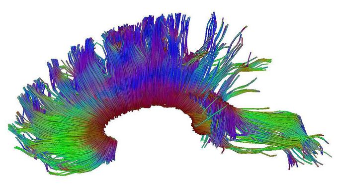 Corpus Callosum MRI tractography